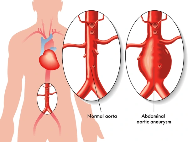 aortic root aneurysm 1.webp